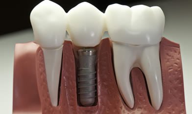 Dr. Carlos Garcia, Bright Smiles Dental Studio Image Of Dental Implant