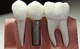 Dr. Carlos Garcia, Bright Smiles Dental Studio Image Of What Is the Minimum Age to Get Dental Implants?
